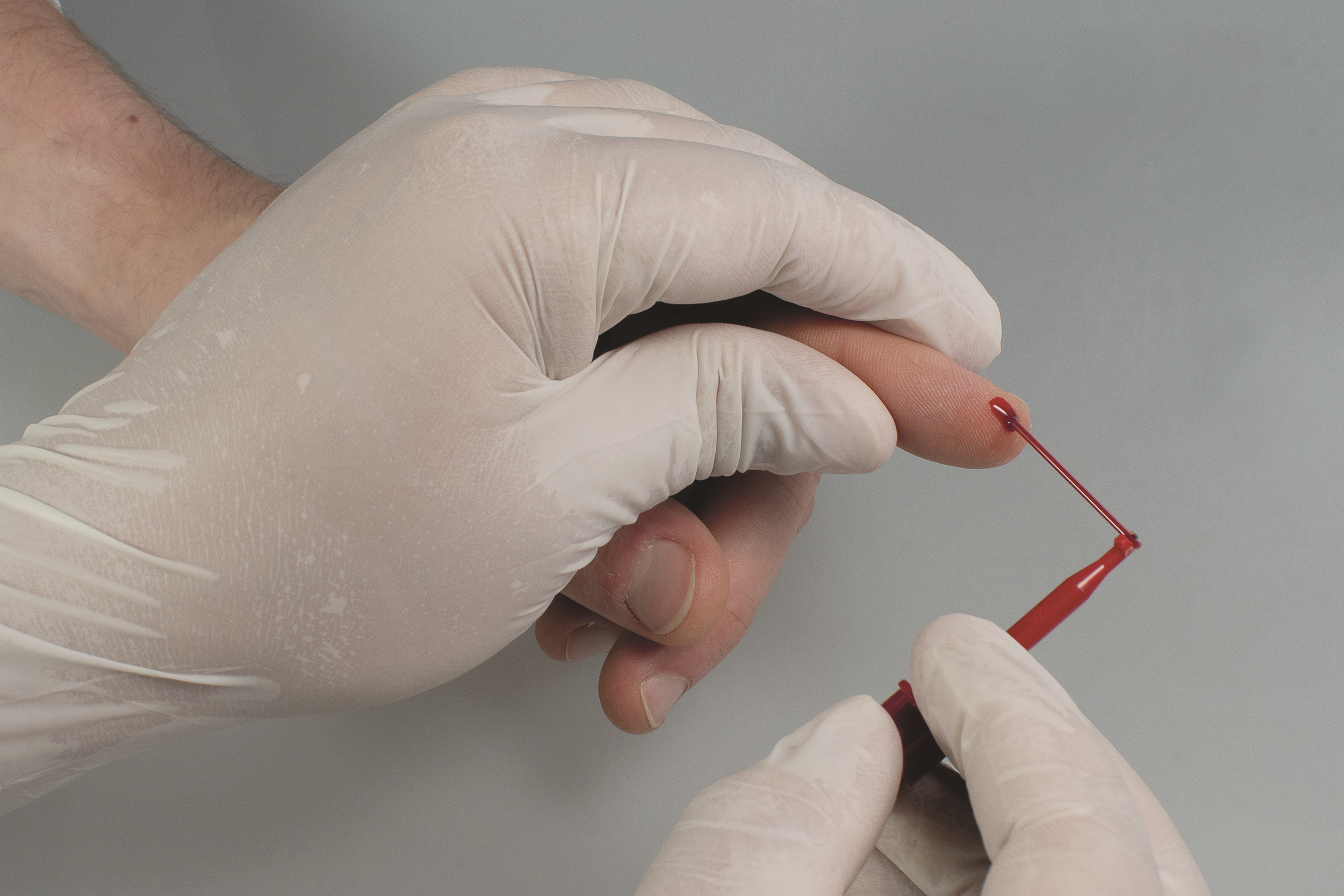 Moderne labordiagnostische Möglichkeiten bei alkoholbedingten Störungen